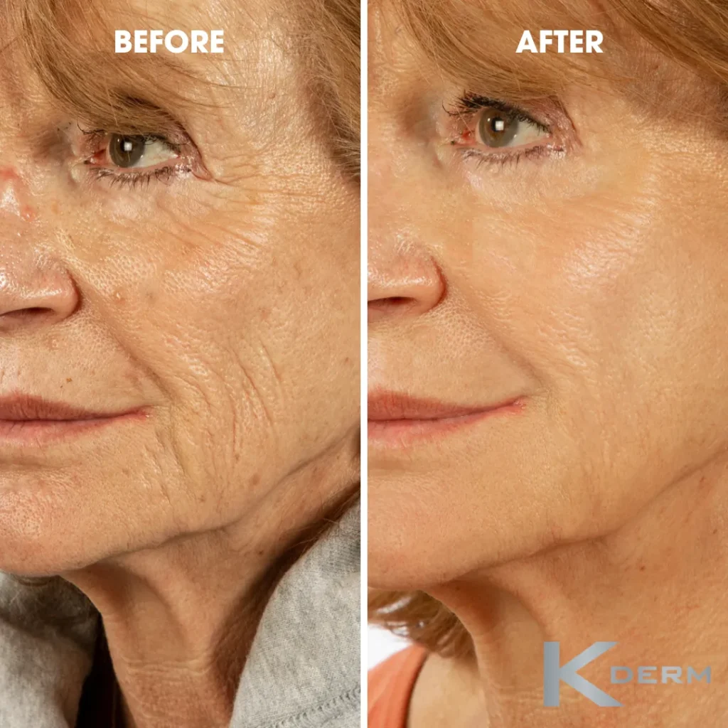 Ảnh trước và sau khi sử dụng sản phẩm LIFTER