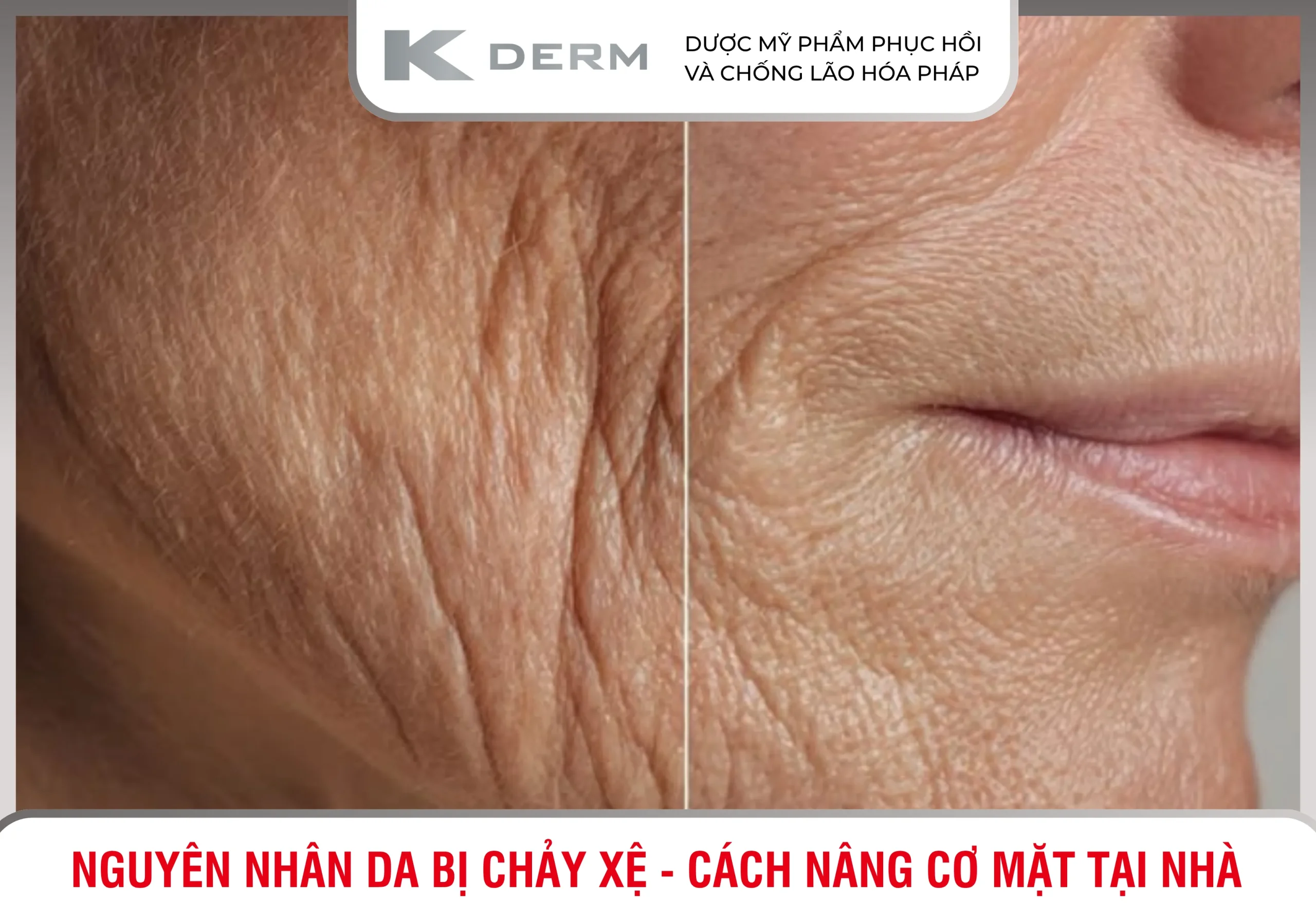 Da bị chảy xệ, da mất đàn hồi là gì